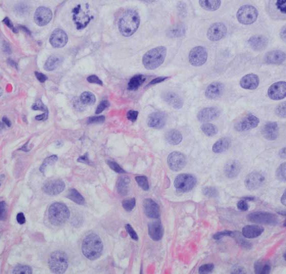 blasenkrebs_istock-599146372