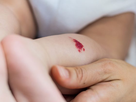 haemangiom_istock-1188439498