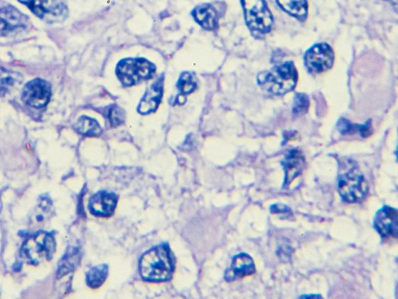 hodenkrebs_istock-908151202