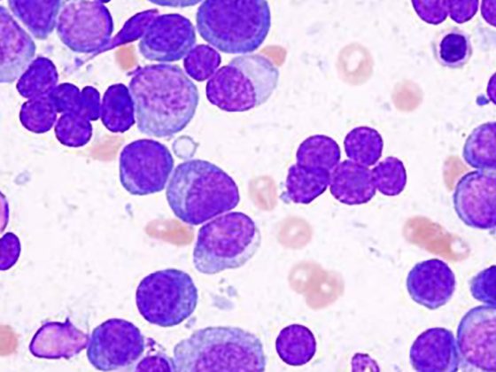 multiple_myeloma