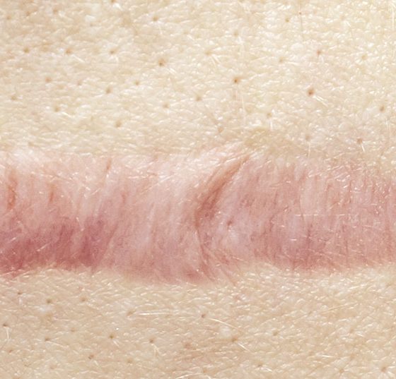 narbe_istock-1142492665