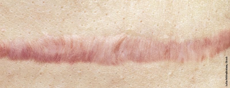 narbe_istock-1142492665