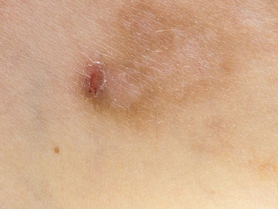 prurigo_istock-1203630687