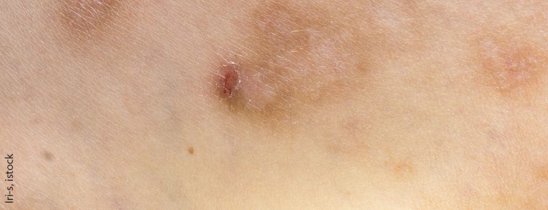 prurigo_istock-1203630687