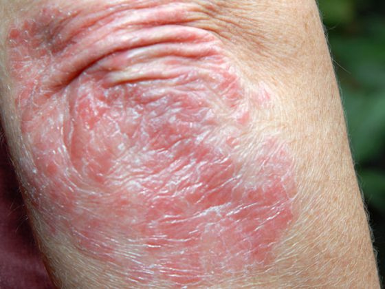 psoriasis_istock-157382601