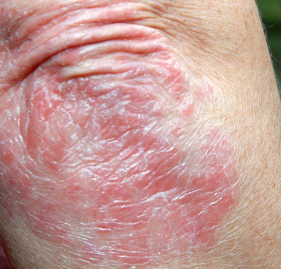 psoriasis_istock-157382601