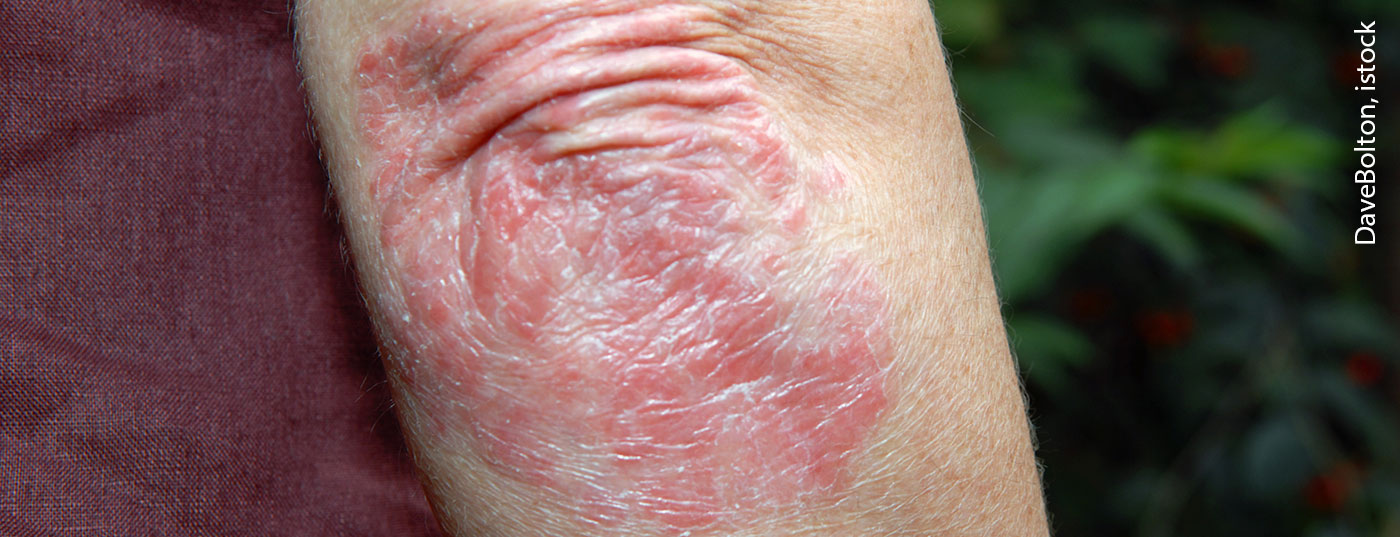 psoriasis_istock-157382601