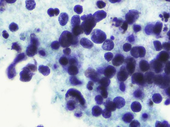 smallcell_carcinoma_istock-801273964