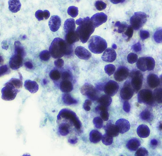 smallcell_carcinoma_istock-801273964