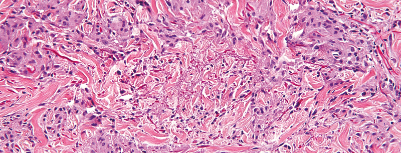 granuloma_anulare