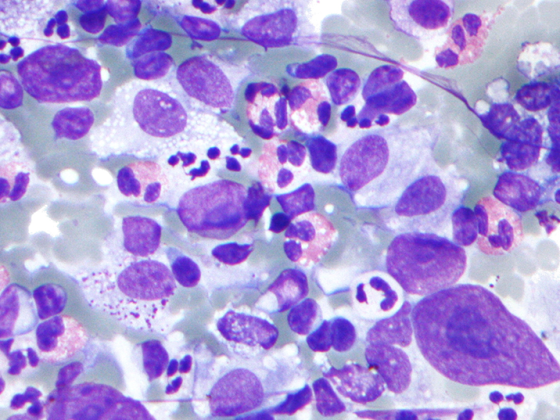 hodgkin_lymphoma_cytology_large