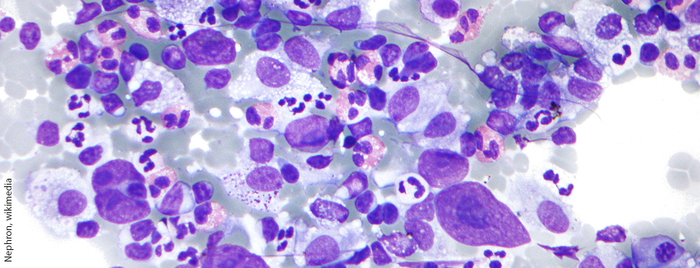 hodgkin_lymphoma_cytology_large
