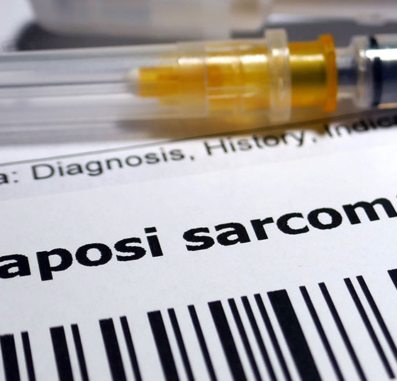 kaposi_istock-1128845466
