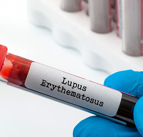 lupus_sle_istock-1210670543
