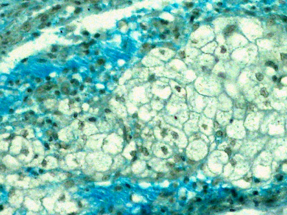 mycosisfungoides