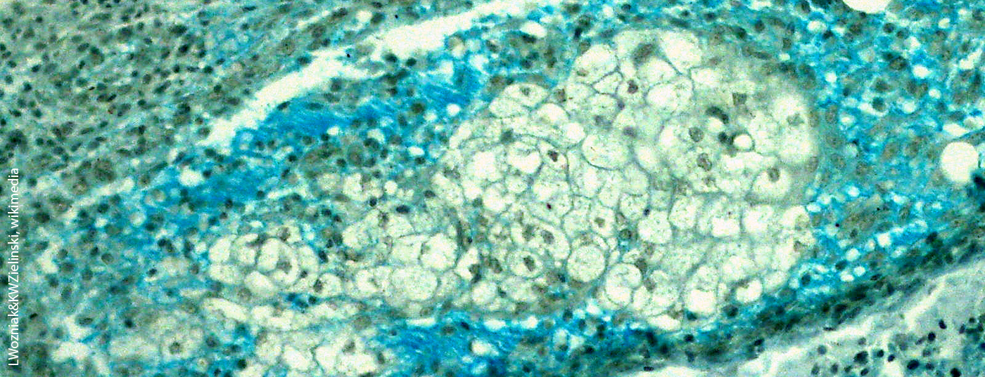 mycosisfungoides