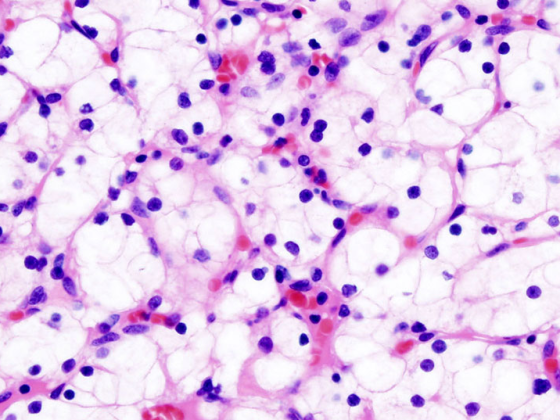 nierenkrebs_nierenkarzinom_wikimedia-free