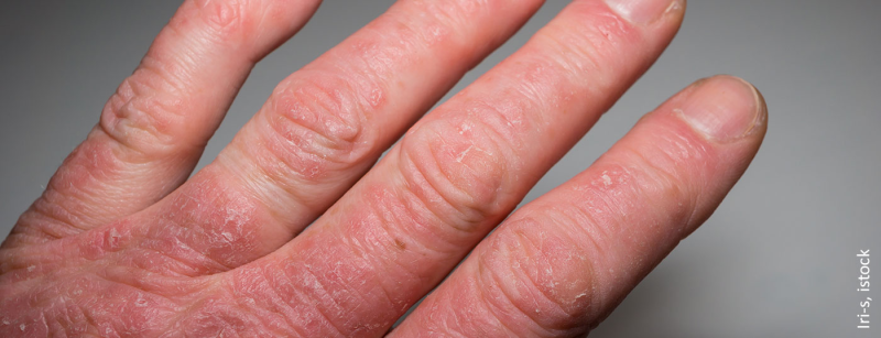 psoriasis-arthritis_istock-1176340885