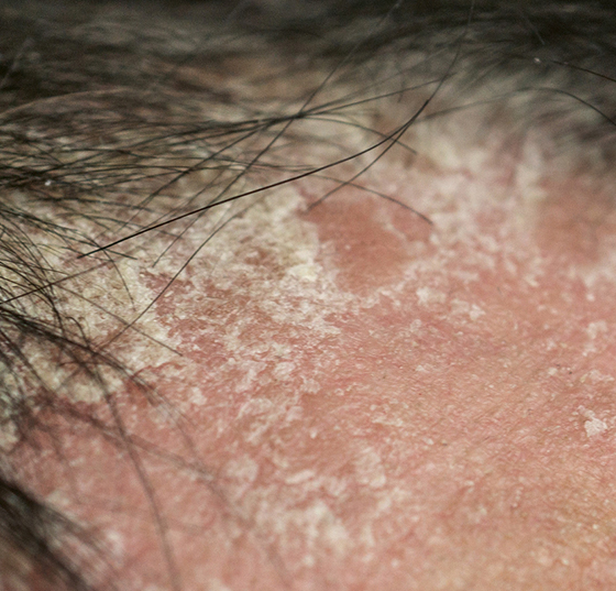 psoriasis_kopfhaut_istock-1127052066