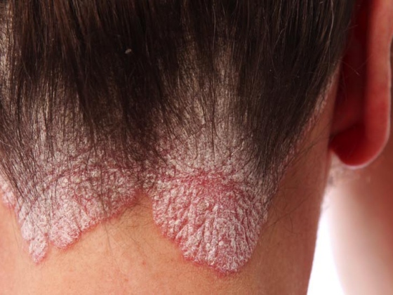 schuppenflechte_psoriasis