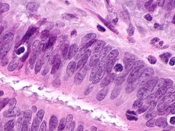 tumour-infiltrating_lymphocytes