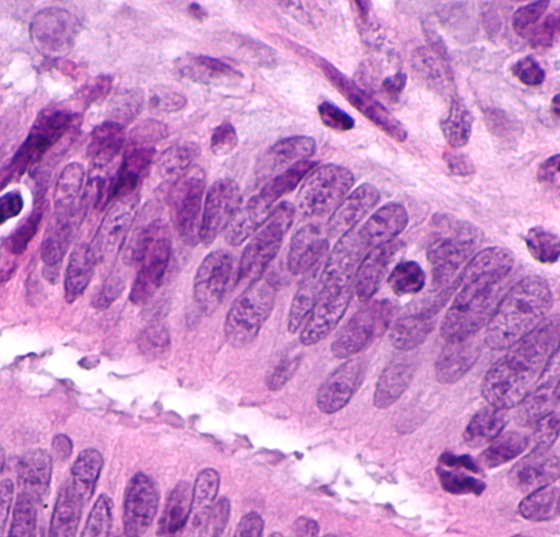 tumour-infiltrating_lymphocytes