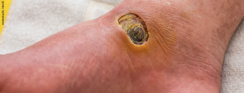 diabetes_fuss_istock-840170500