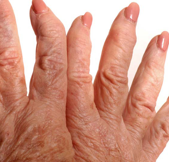 rheuma-arthritis_hand