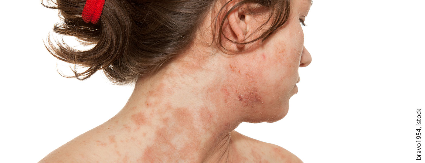atopische_derma_istock-165665917