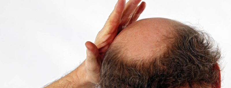 glatze_alopezie
