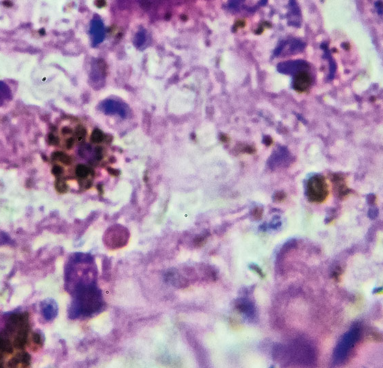 melanom_biopsie_istock-908465636