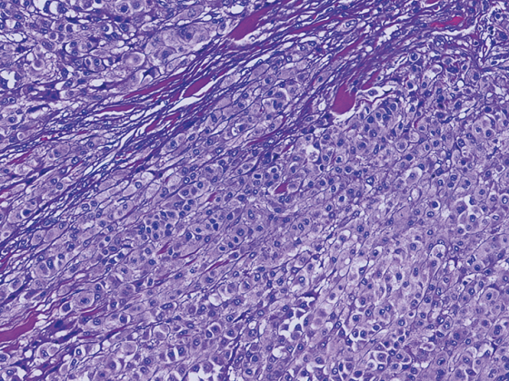 melanom_metastasierend_istock-1128205143