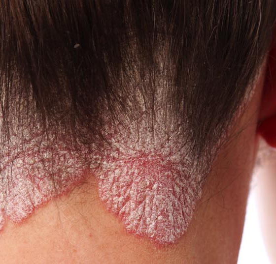 schuppenflechte_psoriasis