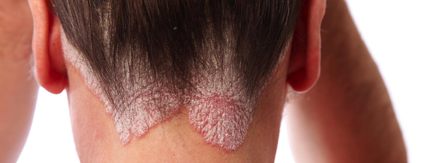 schuppenflechte_psoriasis