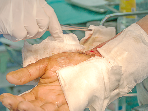 wunde_verbrennung_istock-947392946