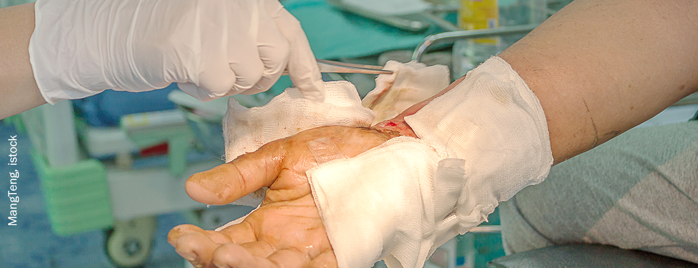 wunde_verbrennung_istock-947392946