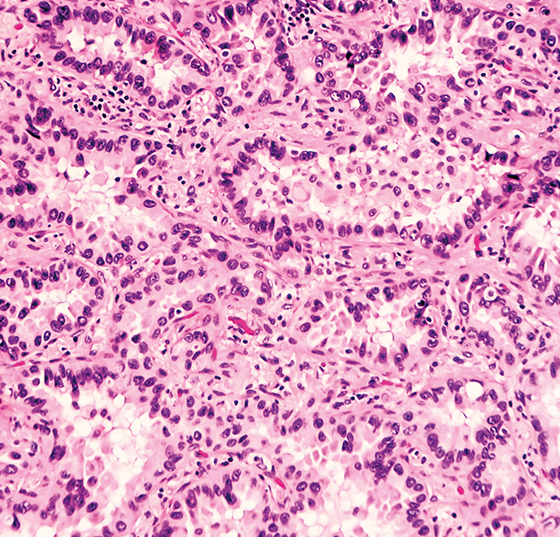 adenokarzinom_istock-531314236