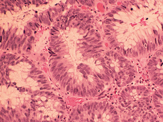 darmkrebs_istock-187930068