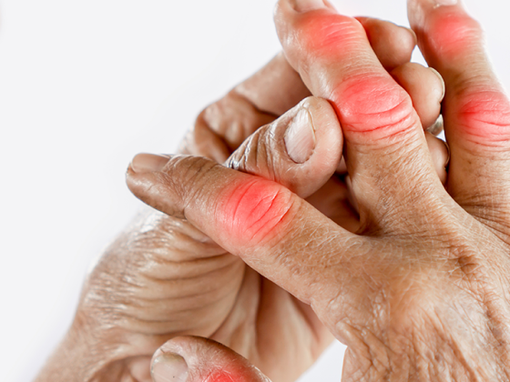gicht_arthrose_istock-1188861544