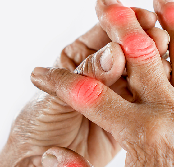 gicht_arthrose_istock-1188861544