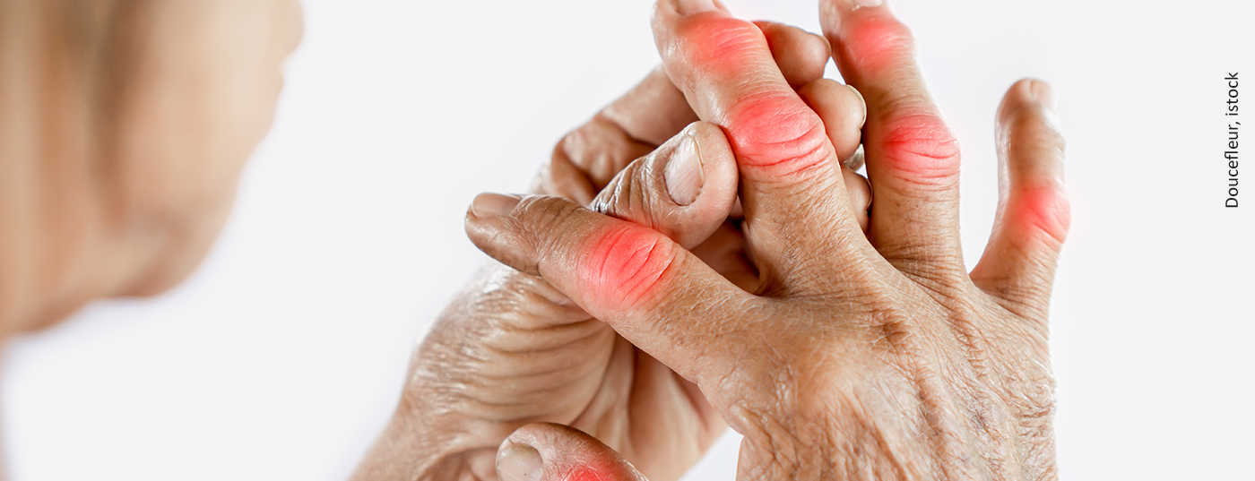 gicht_arthrose_istock-1188861544