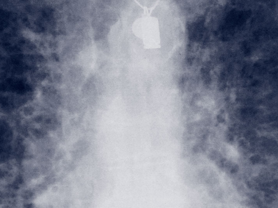 lungenfibrose_ipf_amiodarone