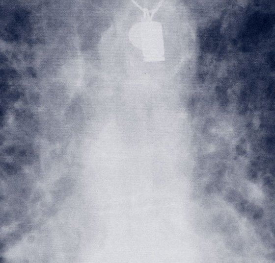 lungenfibrose_ipf_amiodarone