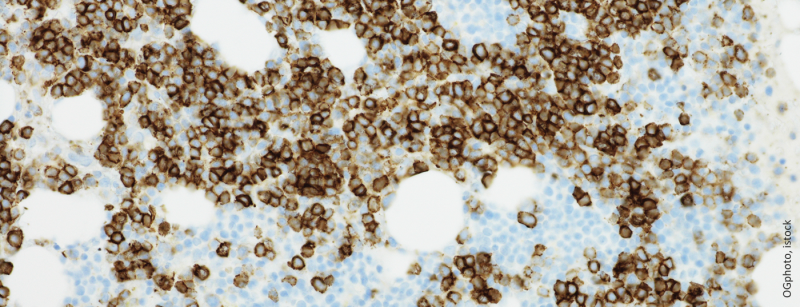 multiplesmyeloma_istock-680297884