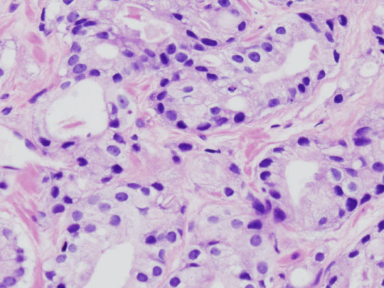 prostatakrebs_histo2