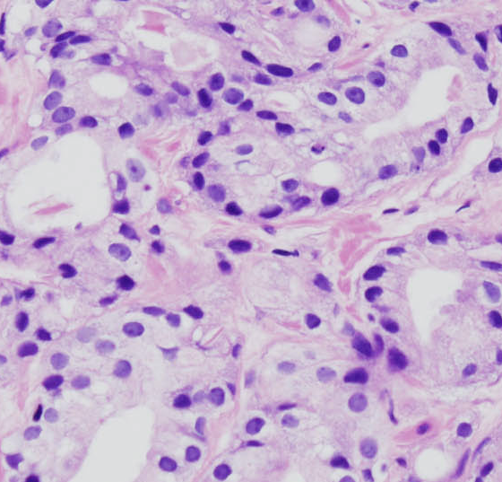 prostatakrebs_histo2