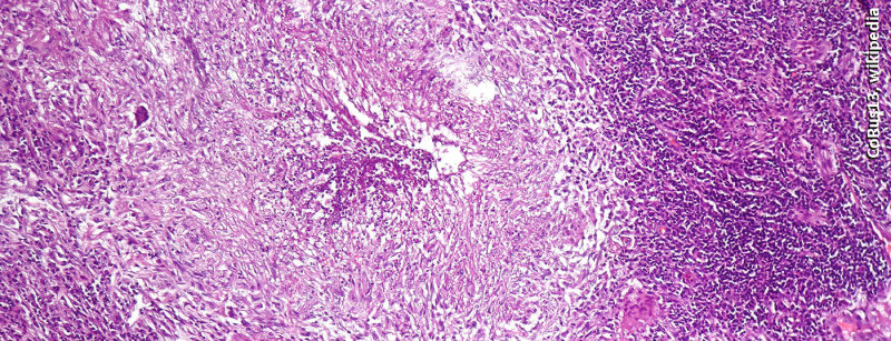 tuberkulose_lunge_wikipedia