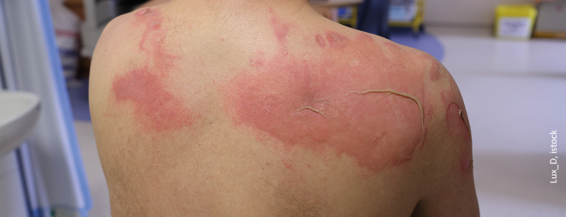 verbrennung_verbruehung_istock-176230806