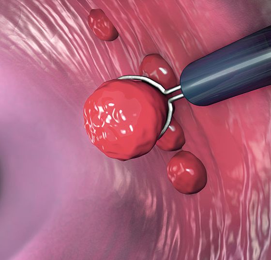 darm_darmkrebs_istock-1136901766