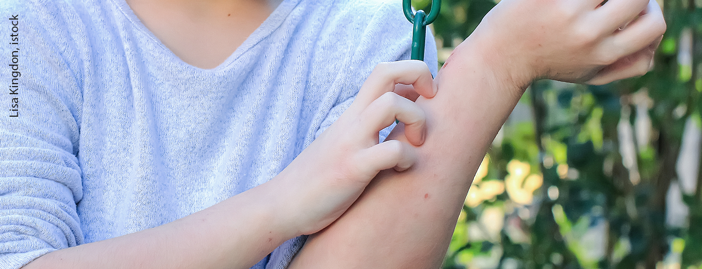 ekzem_neurodermitis_istock-1137613904